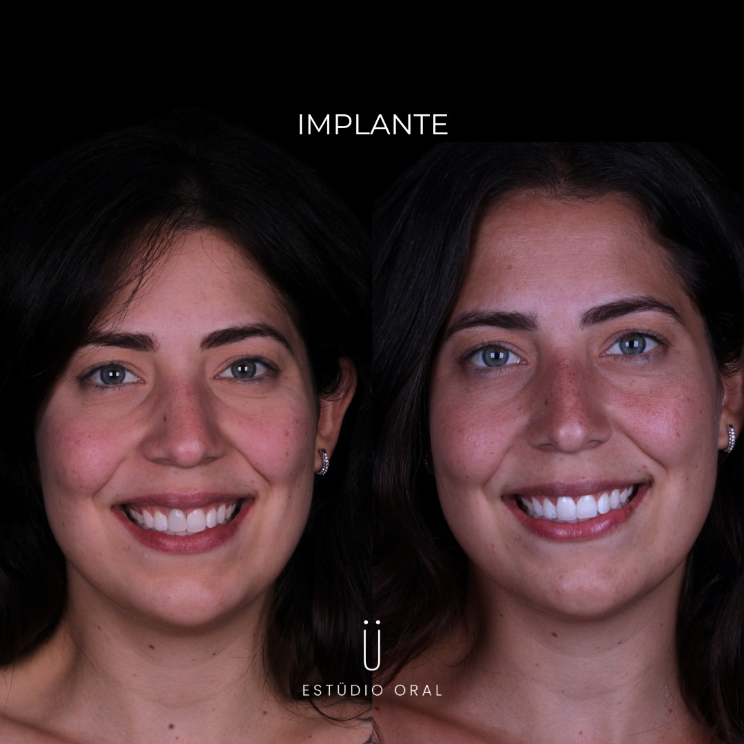 Caso de implante dentário - antes e depois