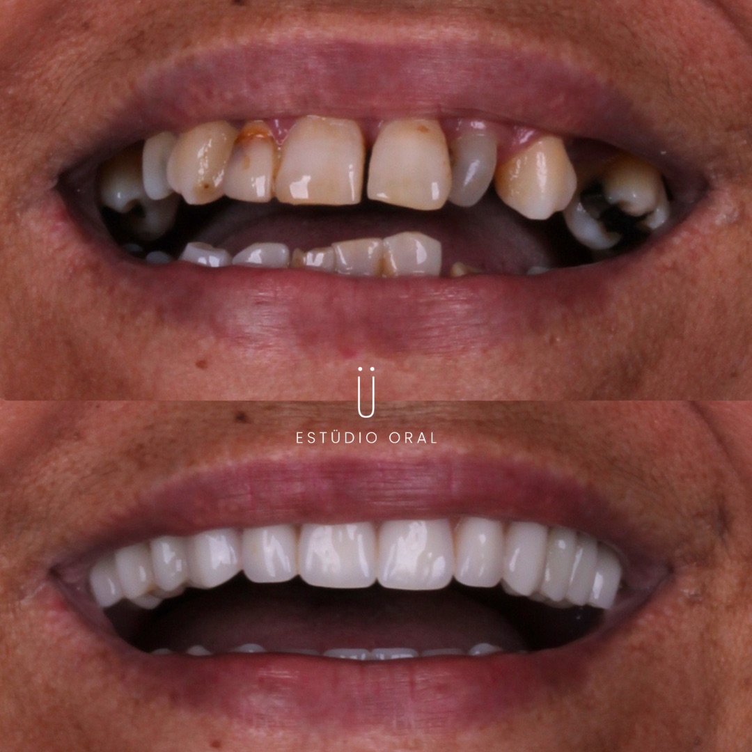 Caso Prótese Protocolo - antes e depois