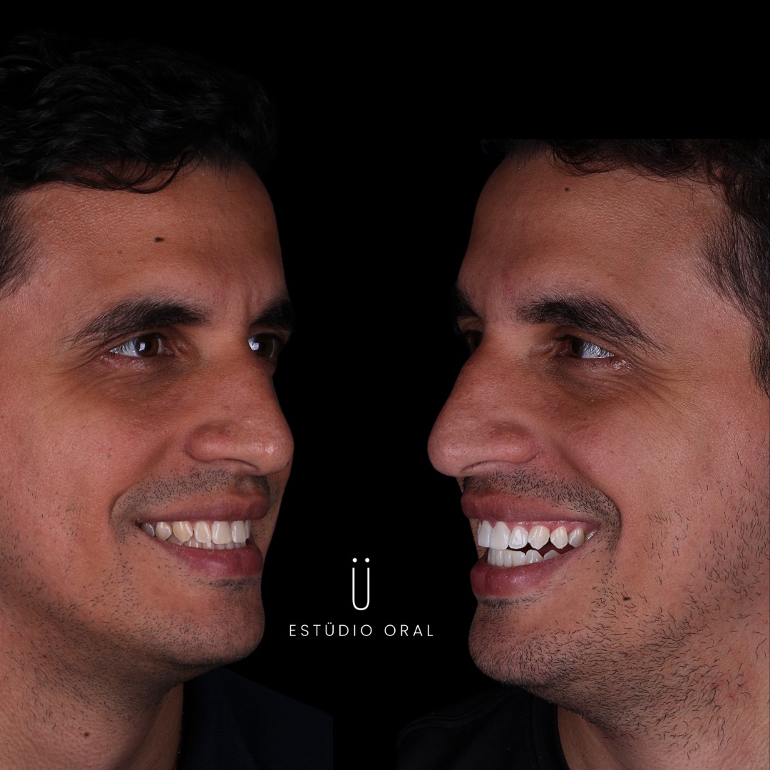 Resultado - Clareamento