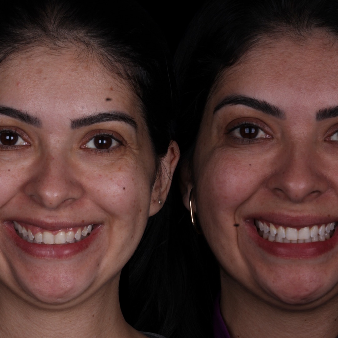 Resultado - Gengivoplastia