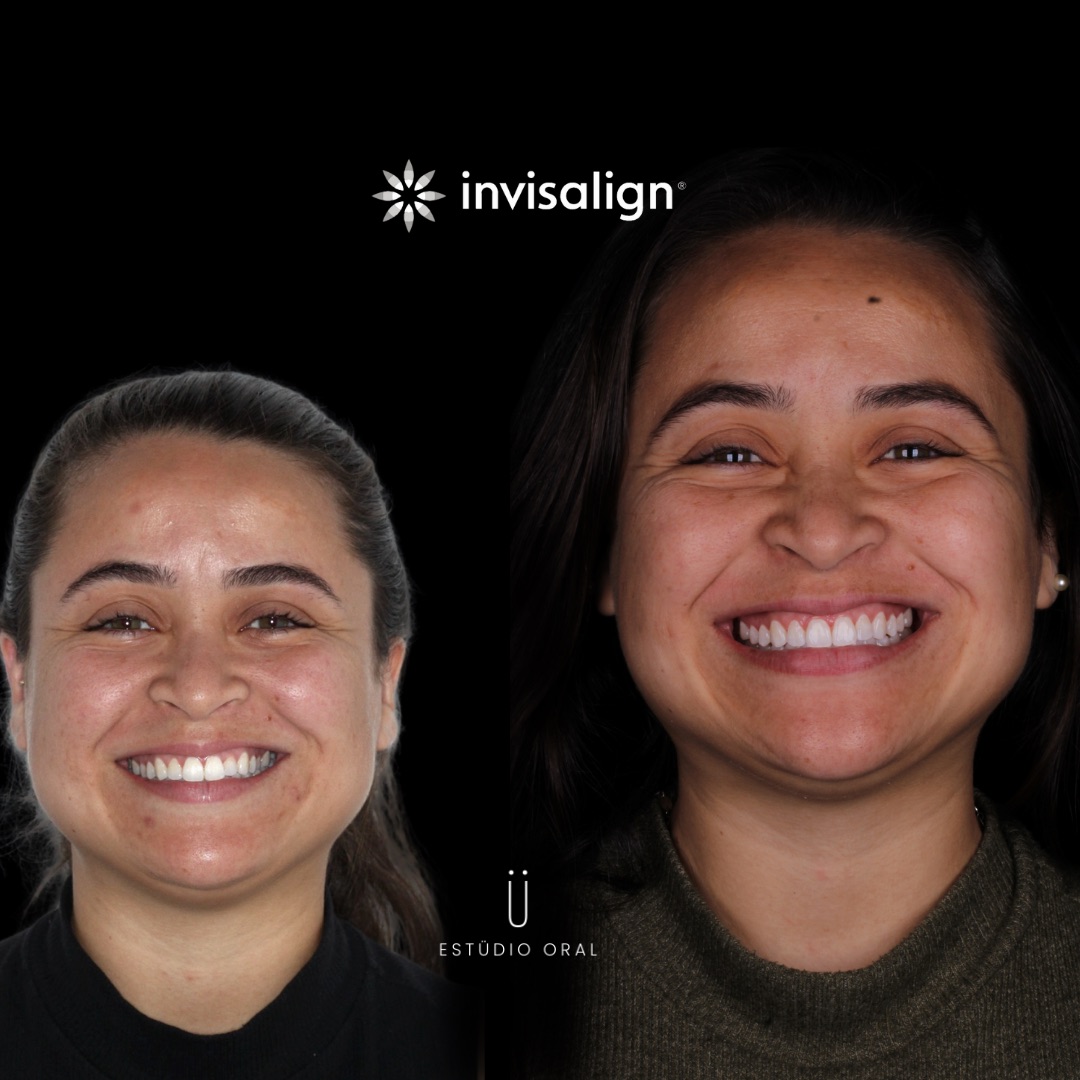Resultado - Invisalign