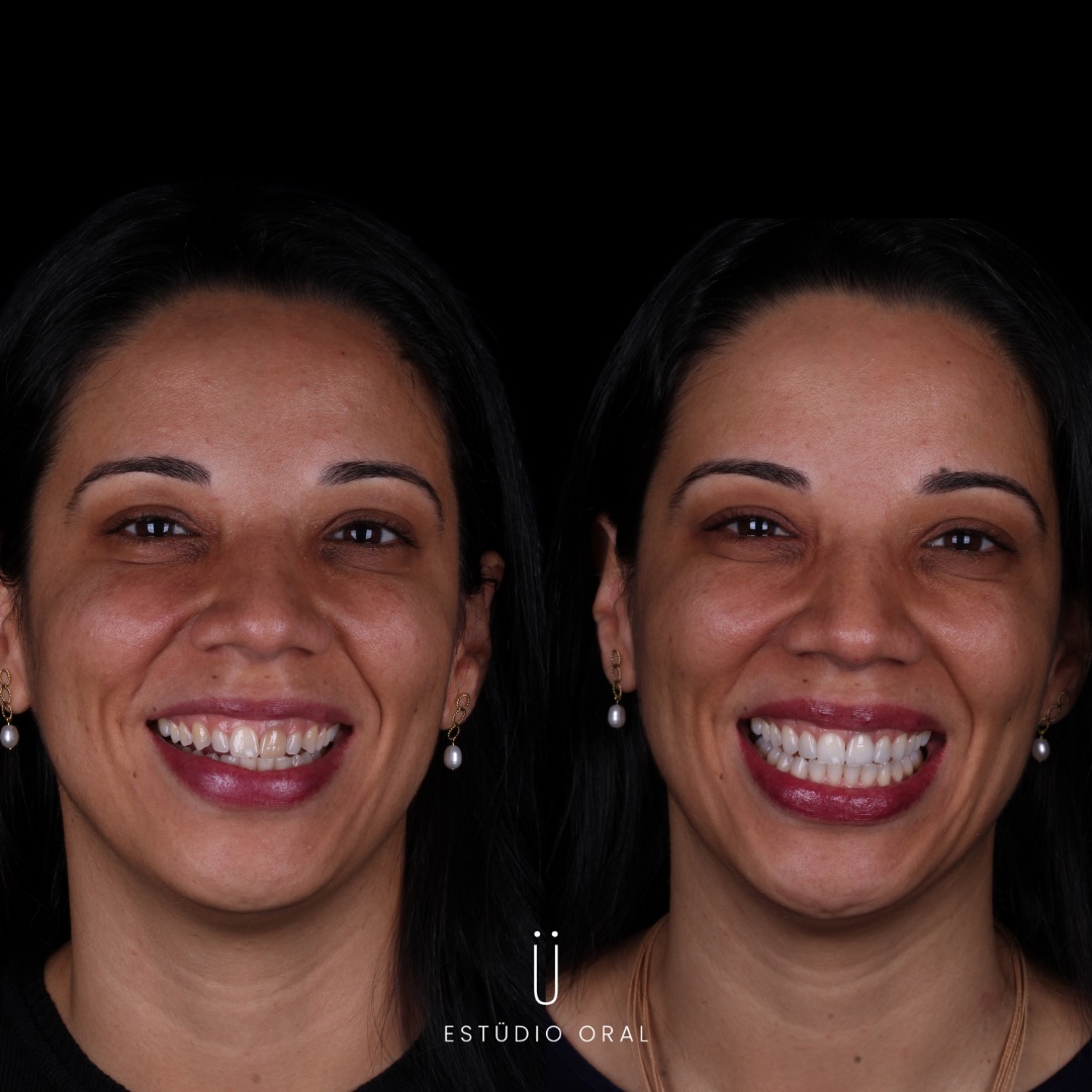 Resultado - Lentes e Facetas