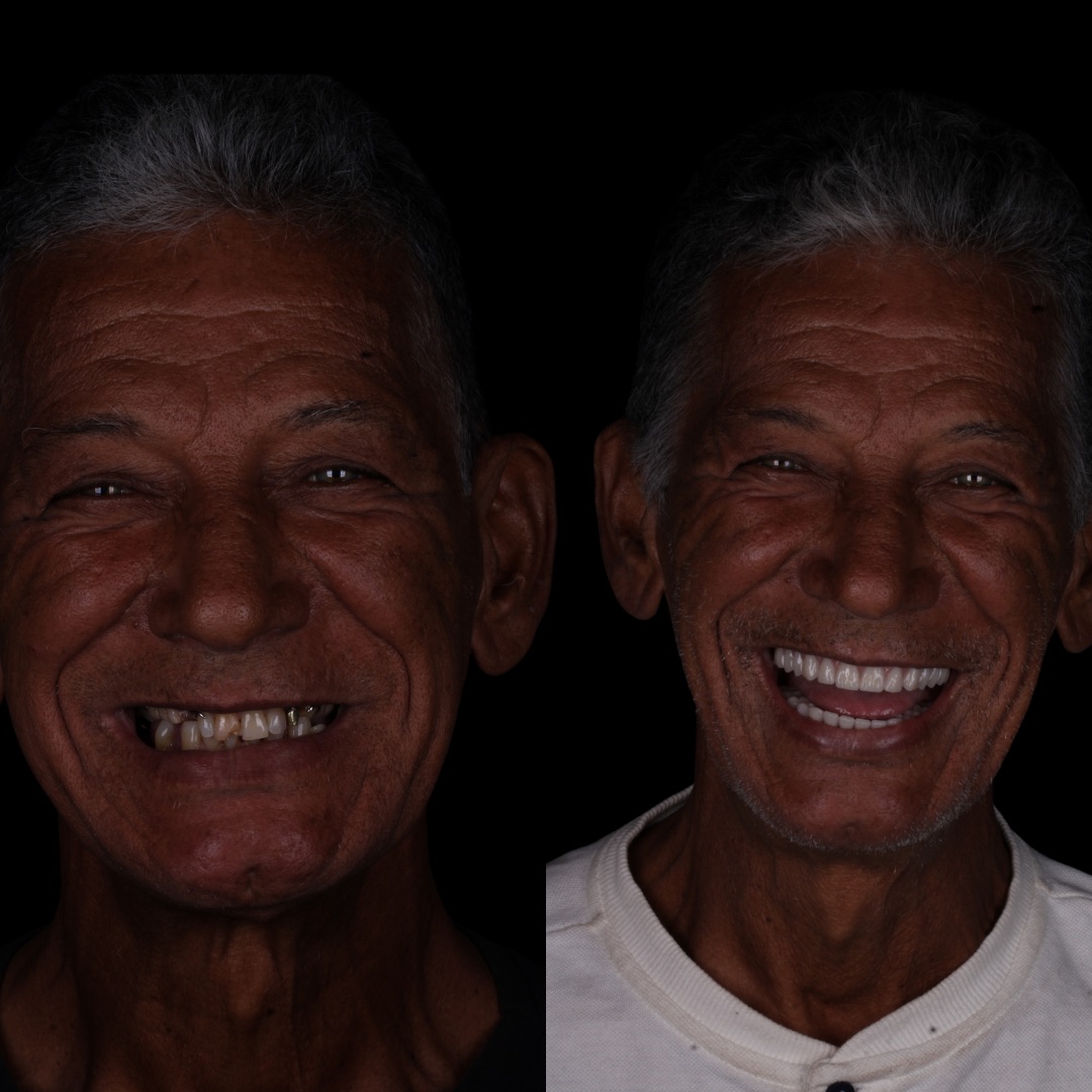 Resultado - Prótese Protocolo